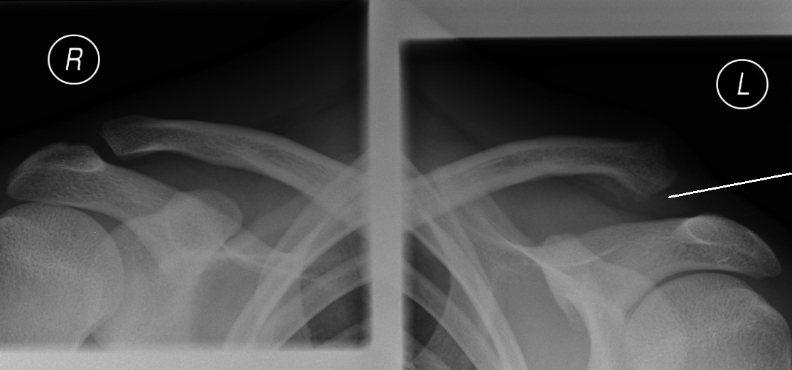 Acromioclavicular joint thesis 06 image