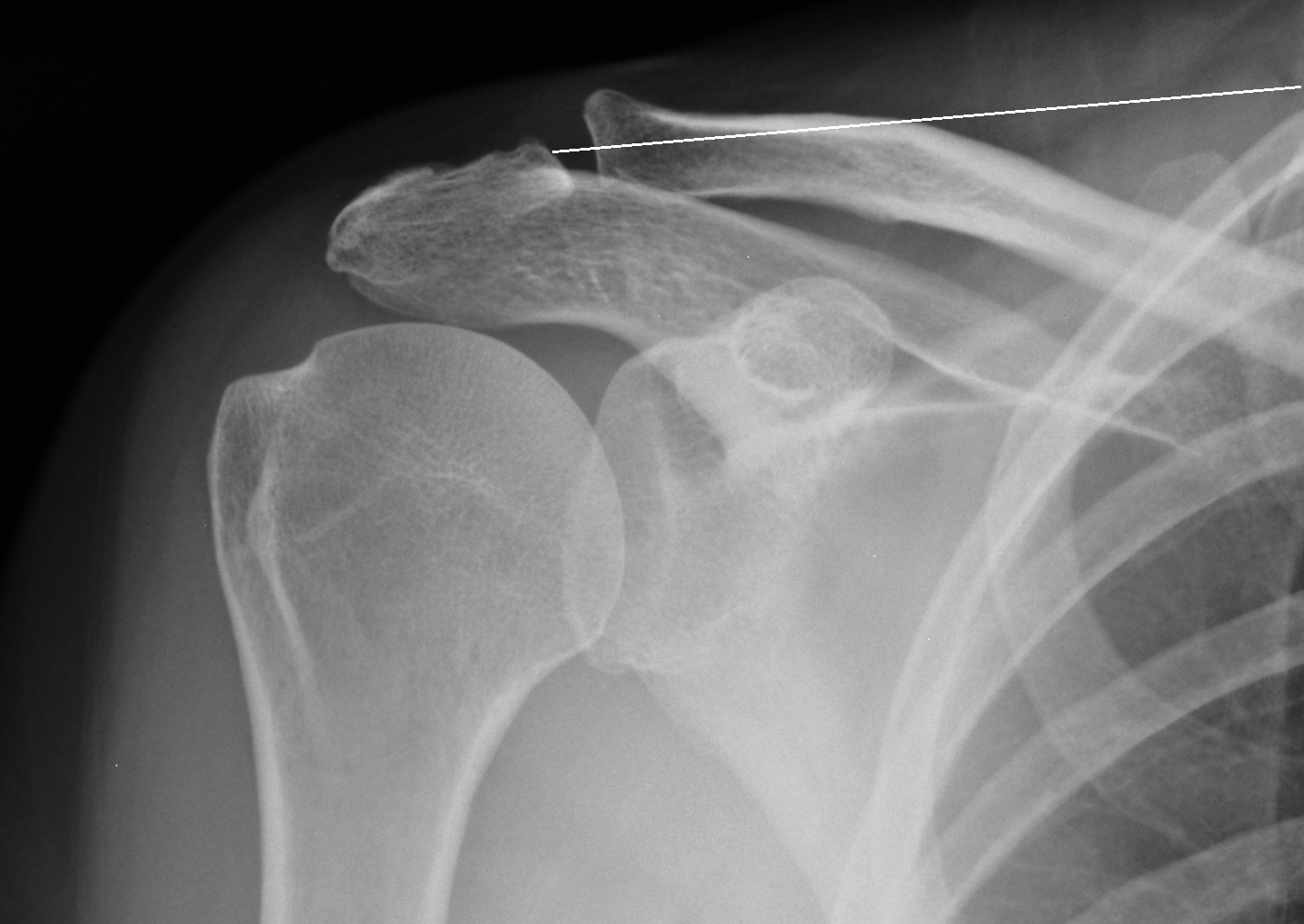 Acromioclavicular joint separation treatment picture